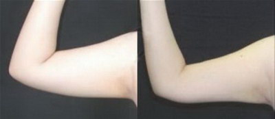 手臂吸脂恢复过程图「手臂吸脂恢复过程」