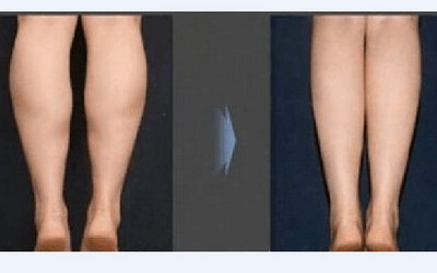 如何瘦大腿的外侧根部_如何瘦大腿根外侧的肌肉