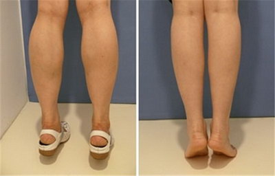 腿部吸脂一次能瘦多少(腿部吸脂能带来巨大的瘦身效果吗？)