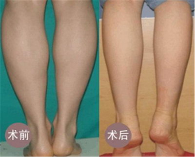大腿抽脂后发紫正常吗_大腿抽脂的恢复时间有多久