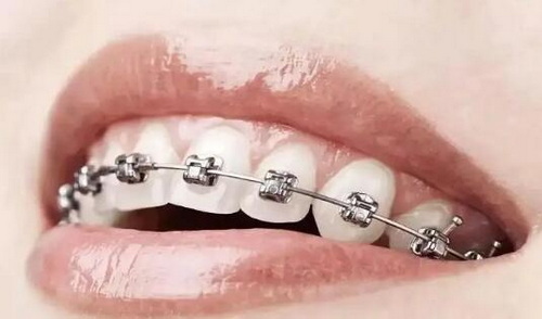 牙齿整形后有什么副作用吗_牙齿整形怎么处理才能彻底好