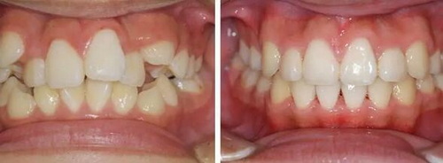 根管治疗后牙套可以取下来吗_根管治疗后牙套使用寿命