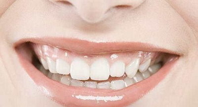 中度氟斑牙冷光美白有用吗(中度氟斑牙冷光美白是有效的吗？)