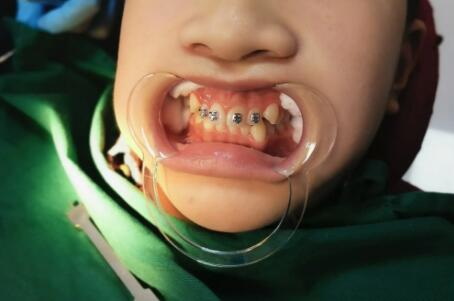 牙黄可以通过洗牙变白吗(牙黄可以通过洗牙解决吗)