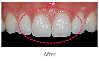 根管治疗戴牙套需要多久时间_根管治疗戴牙套一般管多少年