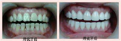 拔牙后一直牙疼怎么缓解_拔牙后周围的牙疼正常吗