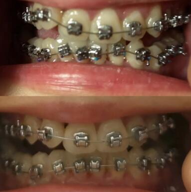 洗牙对牙齿有什么负面的影响吗(用什么洗牙齿最白)