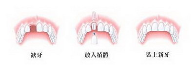 蛀牙的治疗和预防(蛀牙的预防和治疗)