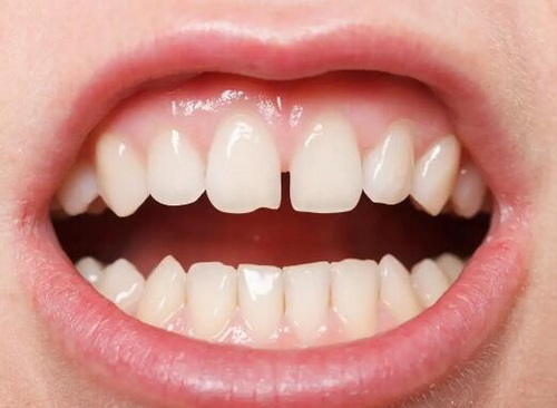 牙齿美白是什么症状(牙齿美白有什么症状)