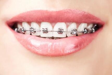 做过根管治疗的牙齿可以做矫正吗(做过根管治疗的牙齿要怎么洗牙)