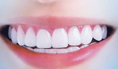 种植牙牙龈发白是正常吗(种植牙牙龈发白什么原因)