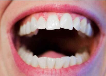 牙齿坏了不补会影响其他牙吗【牙齿掉了一个会影响其他的吗】