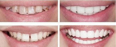 种植牙在牙槽骨里部分有异物感吗