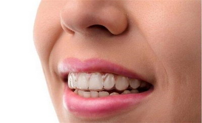 牙齿黑三角戴牙套多久容易出现[牙齿黑三角戴牙套]
