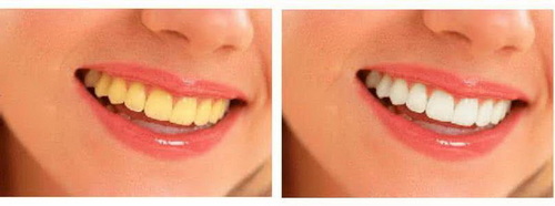 牙周炎治疗后多久可以刷牙「拔牙后多久可以做牙周炎治疗」