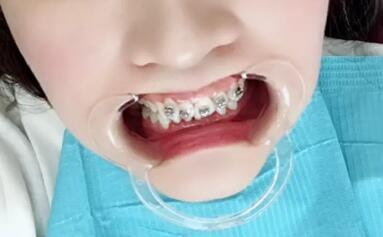 儿童牙龈上长个小牙齿是怎么回事