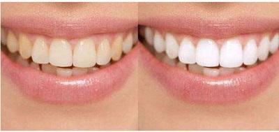 矫正牙齿导致牙槽骨吸收(矫正牙齿导致牙槽骨突出)