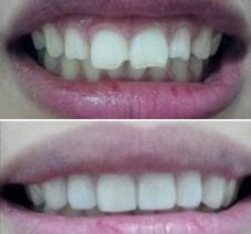 牙齿嵌体和牙冠的区别(牙齿做嵌体还是做牙冠好)