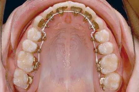 带牙套之后牙龈容易出血_带牙套之后牙疼怎么办