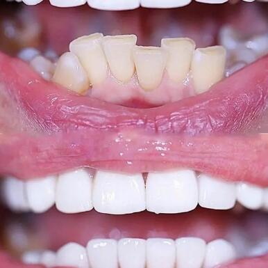 郑州哪个种植牙好_郑州哪个牙科医院种植牙比较好