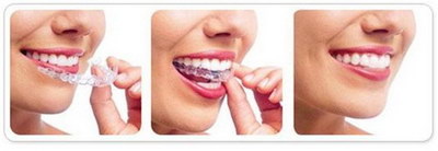 深龋齿治疗费用「乳牙龋齿治疗费用」