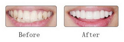 做牙冠和牙套的区别(牙冠与牙套的区别)