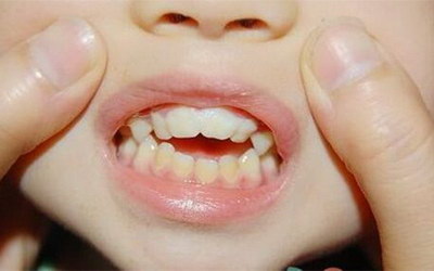 拔牙后牙龈什么时候可以恢复
