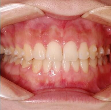 矫正牙齿是什么样的过程【矫正牙齿具体过程是什么样的】