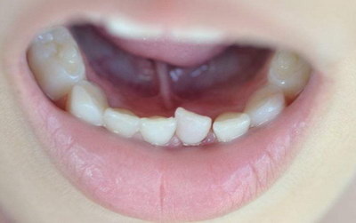 健脾生血颗粒牙齿变黑多久能恢复(健脾生血颗粒牙齿变黑用吸管)