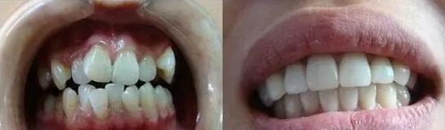 儿童牙齿长在牙龈上会慢慢下来吗