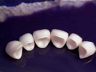 洗牙后牙齿之间有缝「洗牙之后牙齿松动会好吗」