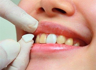 儿童牙齿正畸的最佳年龄