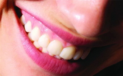 根管治疗玻璃离子暂封可以刷牙吗_根管治疗第一步封药多久可以刷牙