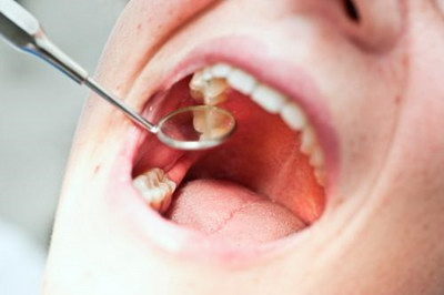 龋齿补牙后能吃东西吗「深龋齿补牙后吃东西酸痛」