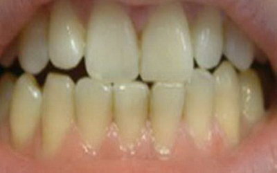 牙龈导致牙齿松动