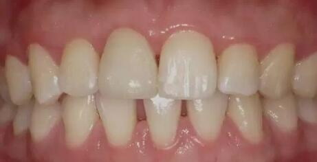 中医治疗牙齿松动的案例(牙齿松动中医治疗医案)