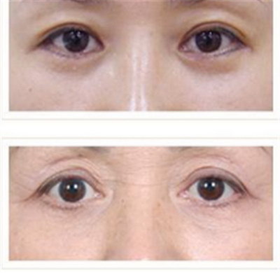 双眼皮术后多久可以做修复手术(双眼皮术后多久可以做修复手术)