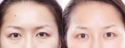 双眼皮怎么画成单眼皮_双眼皮比单眼皮的优势