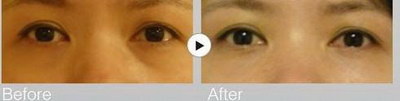 双眼皮术后多久可以做修复手术(双眼皮术后多久可以做修复手术)