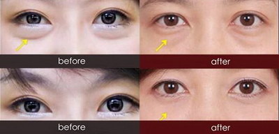 开眼角和割双眼皮的区别图(双眼皮和开眼角的区别)