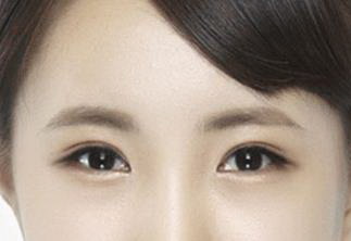 韩式双眼皮哪家医院比较好「做韩式双眼皮哪家医院比较好」