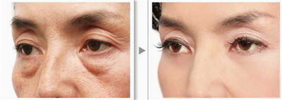 修复切开双眼皮恢复时间「修复切开双眼皮几天能恢复好」