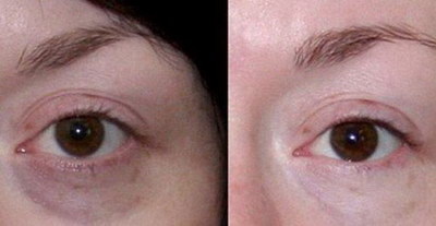 眼皮抽脂手术后注意事项_眼皮抽脂手术恢复需要多长时间