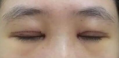 上海哪个医院做双眼皮手术修复最好_上海哪里做双眼皮手术比较好