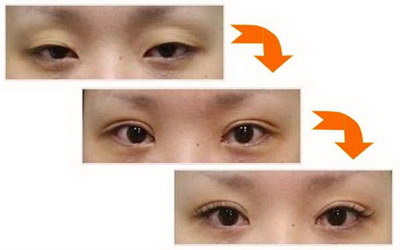 埋线双眼皮手术恢复期15天图_埋线双眼皮手术后眼睛进度不一样
