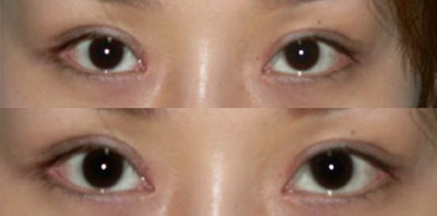 做埋线双眼皮能保持几年_做埋线双眼皮能维持多久