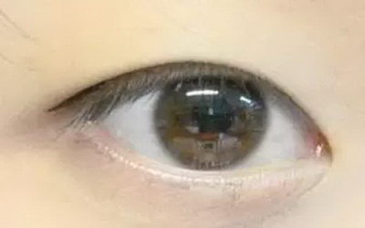 微创双眼皮恢复期眼睛一大一小