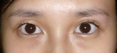 双眼皮手术后还能变单眼皮吗_单眼皮改双眼皮手术效果怎么样