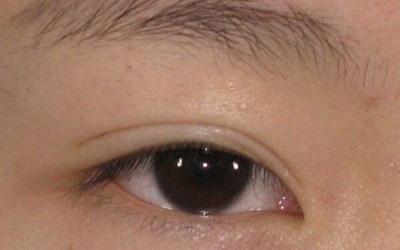 眼睛下方长斑是什么_眼睛下方两侧长斑