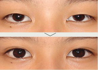 男生单眼皮可以变成双眼皮吗「男生单眼皮怎样拥有双眼皮」